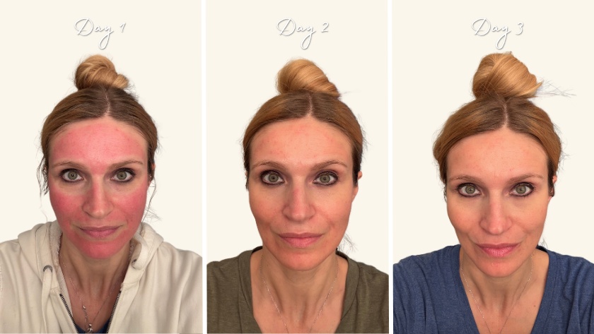 Truly Great Finds - What is Microneedling